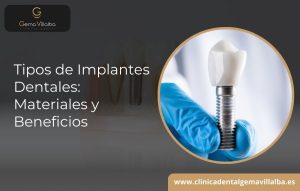 tipos de implantes dentales