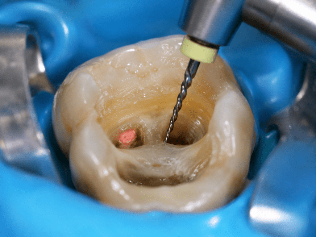 tratamiento-de-endodoncia-merida