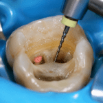 tratamiento-de-endodoncia-merida